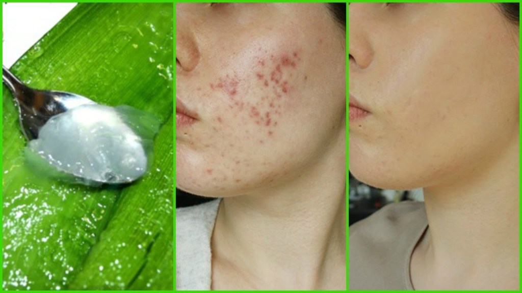 Aloe Vera is the Secret to Clear Skin